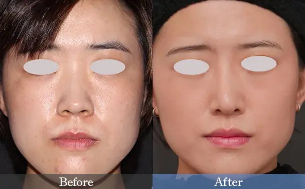 20代女性 Before / After